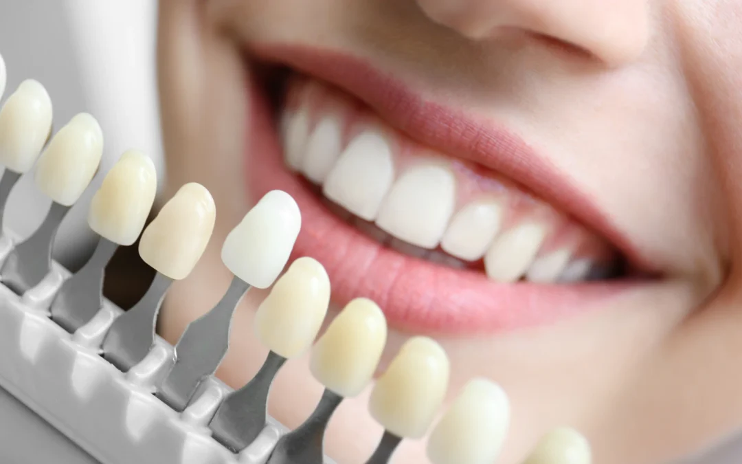 Safe, Lasting Smiles: The Benefits of Professional Teeth Whitening in North Ridgeville, OH