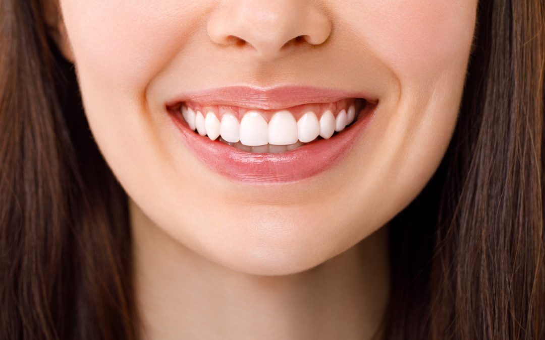 Veneers vs. Bonding: Which Is Better for Your Smile Goals in North Ridgeville, OH?