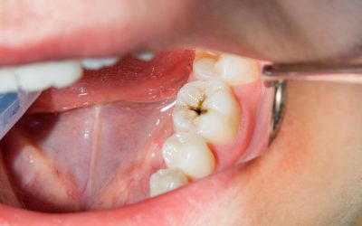 What Happens If a Cavity Is Left Untreated in North Ridgeville, OH?