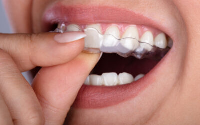 How Clear Aligners Straighten Teeth Over Time in North Ridgeville, OH